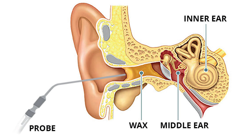 ear wax removal-microsuction
