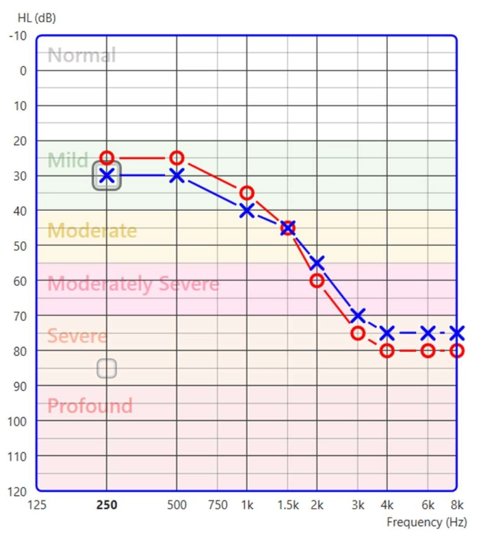 classify the degree of hearing loss chart classify the degree of hearing loss chart